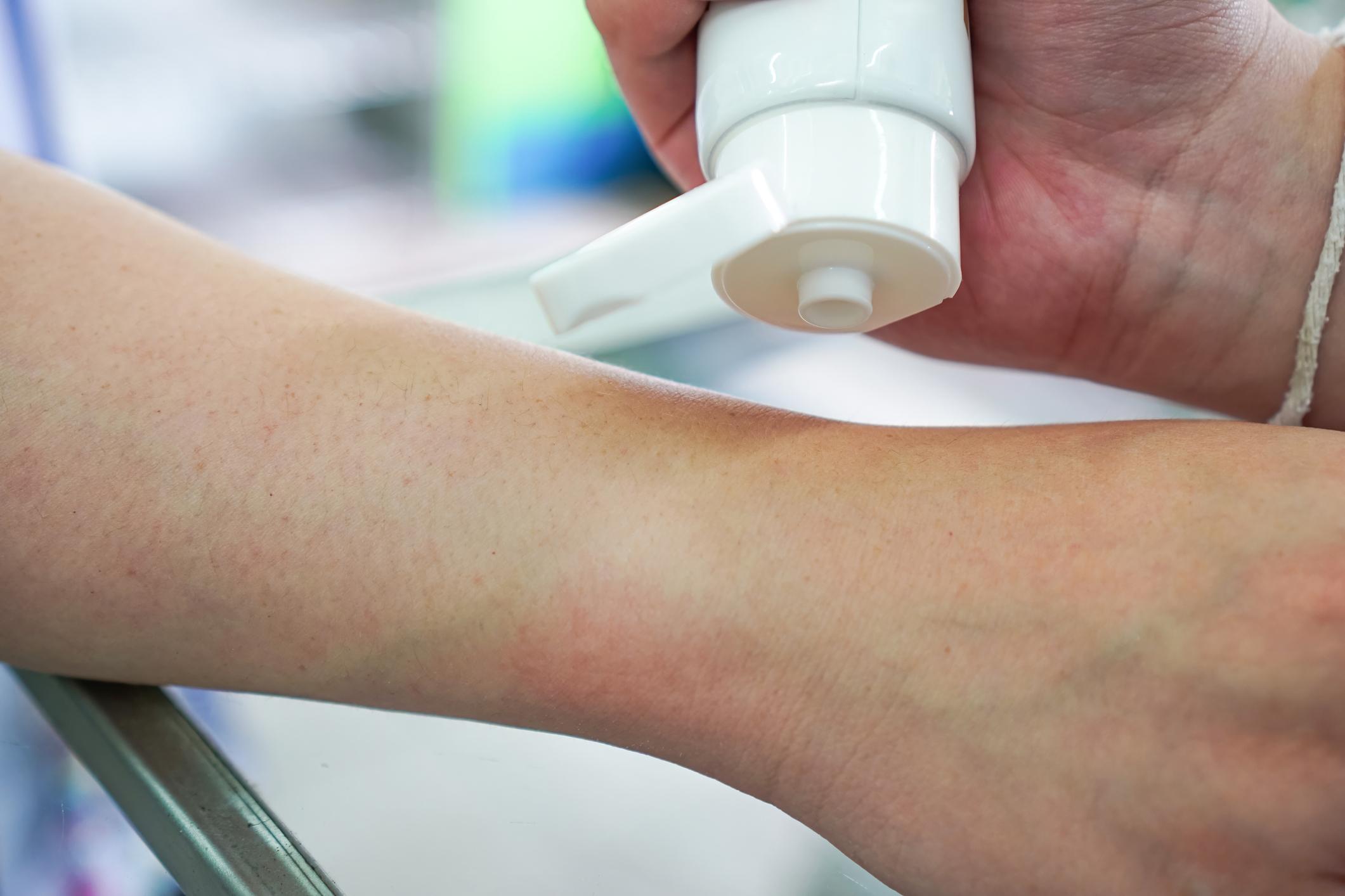 Ketamine Lotion Uses: What Patients Should Know About Topical Ketamine